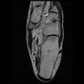 Anterior calcaneal process fracture (Radiopaedia 74654-85611 Axial T2 20).jpg