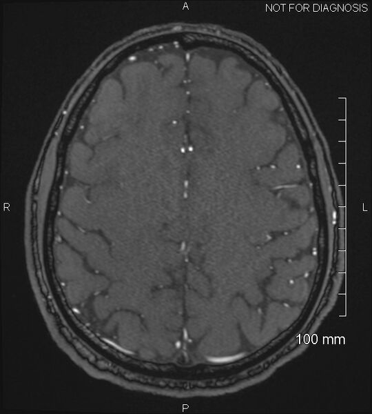File:Anterior cerebral artery aneurysm (Radiopaedia 80683-94127 Axial MRA 187).jpg