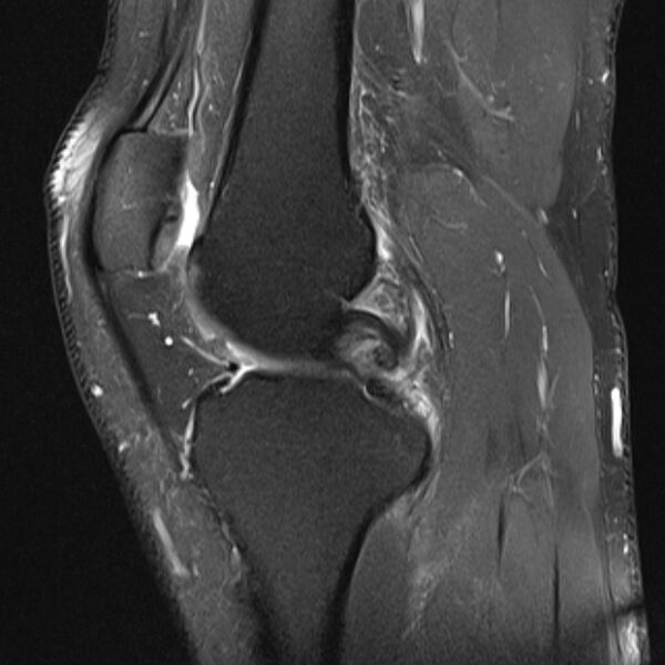 File:Anterior cruciate ligament tear - ramp lesion (Radiopaedia 71883-82322 Sagittal PD fat sat 15).jpg