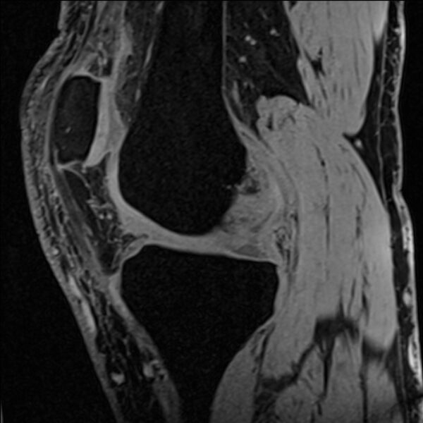 File:Anterior cruciate ligament tear - ramp lesion (Radiopaedia 71883-82322 Sagittal T1 vibe 87).jpg