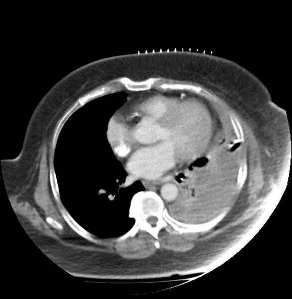 File:Aortic arch false aneurysm (Radiopaedia 14667-14588 A 15).jpg
