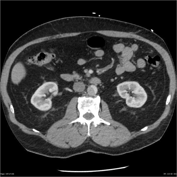 File:Aortic dissection- Stanford A (Radiopaedia 37759-39664 A 100).jpg