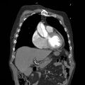 Aortic dissection with rupture into pericardium (Radiopaedia 12384-12647 B 10).jpg