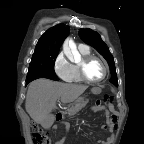 File:Aortic dissection with rupture into pericardium (Radiopaedia 12384-12647 B 10).jpg