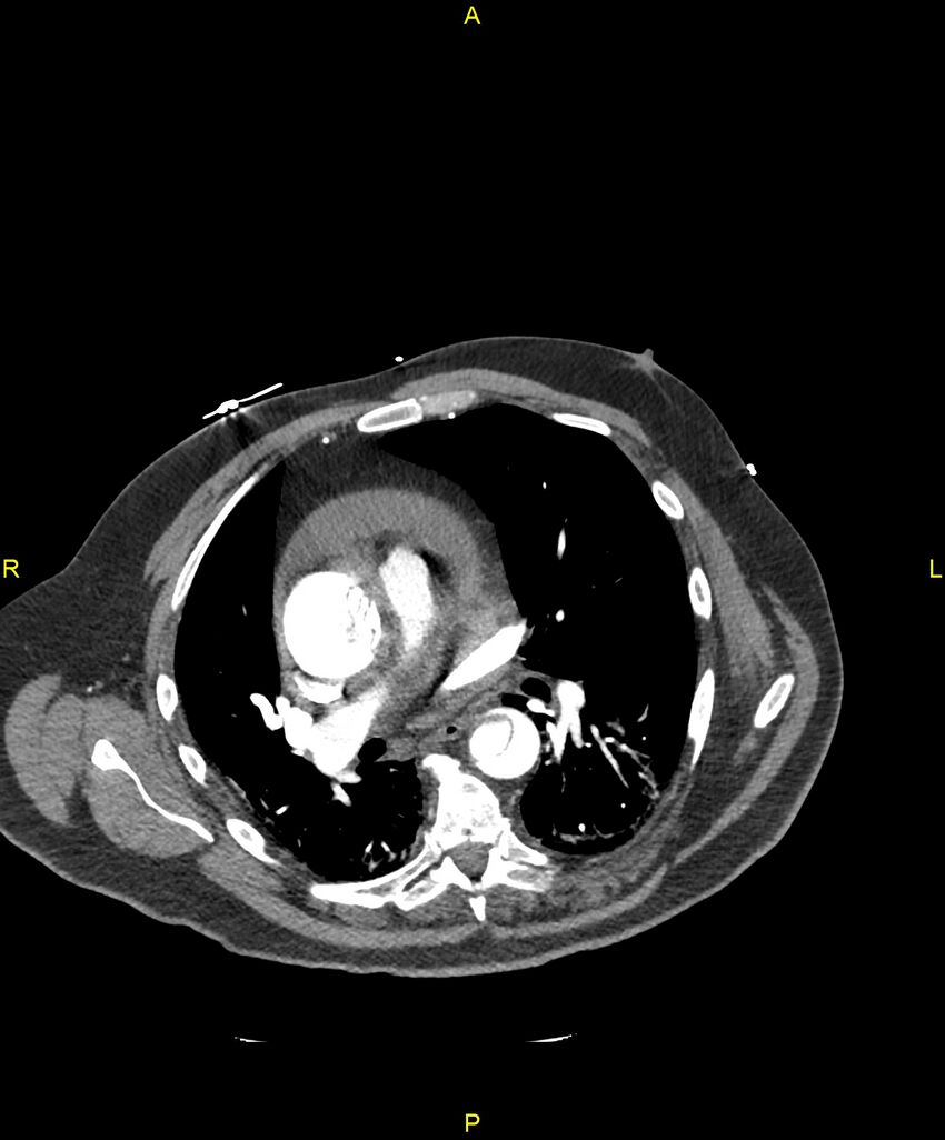 Aortic rupture (Radiopaedia 88822-105594 B 119).jpg
