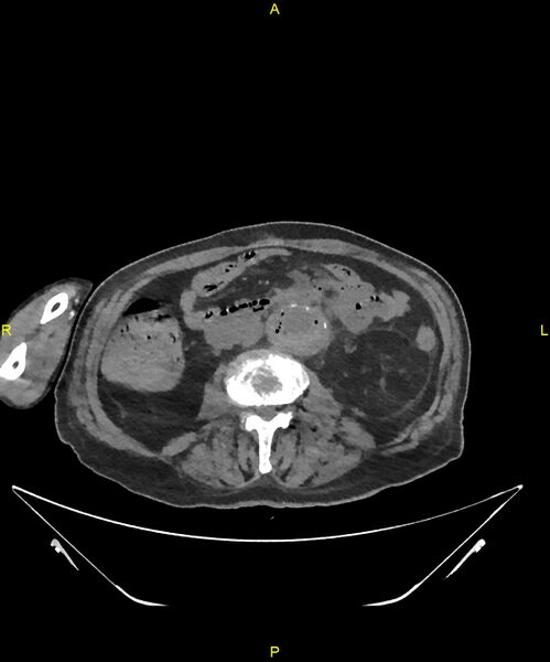 File:Aortoenteric fistula (Radiopaedia 84308-99603 Axial non-contrast 190).jpg