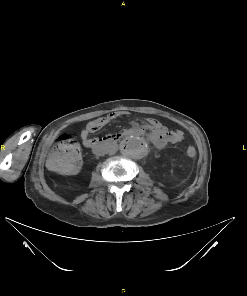Aortoenteric fistula (Radiopaedia 84308-99603 Axial non-contrast 190).jpg
