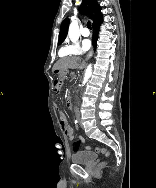 File:Aortoenteric fistula (Radiopaedia 84308-99603 C 170).jpg