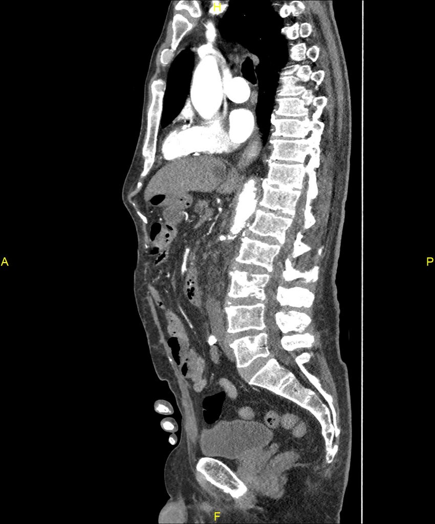 Aortoenteric fistula (Radiopaedia 84308-99603 C 170).jpg
