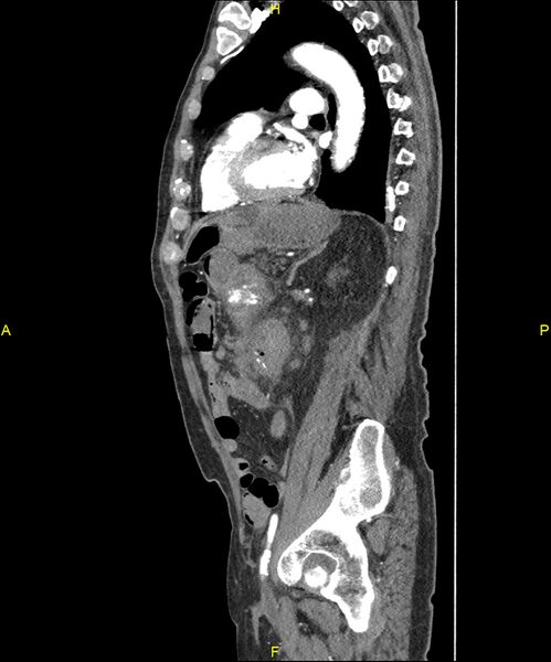 File:Aortoenteric fistula (Radiopaedia 84308-99603 C 224).jpg
