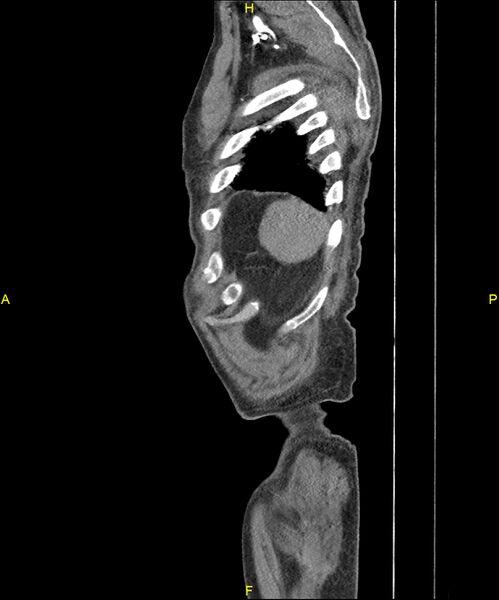 File:Aortoenteric fistula (Radiopaedia 84308-99603 C 314).jpg