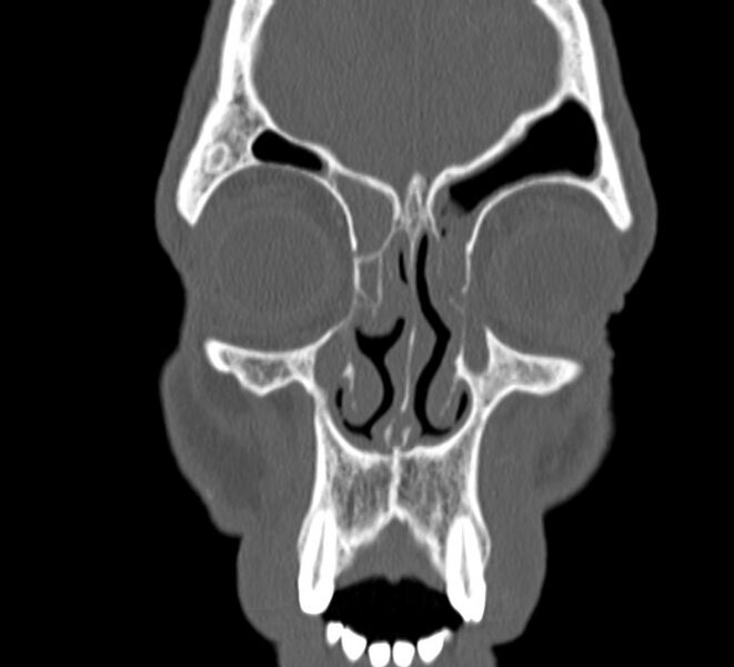 File:Aplastic maxillary sinuses (Radiopaedia 60030-67561 Coronal non-contrast 10).jpg