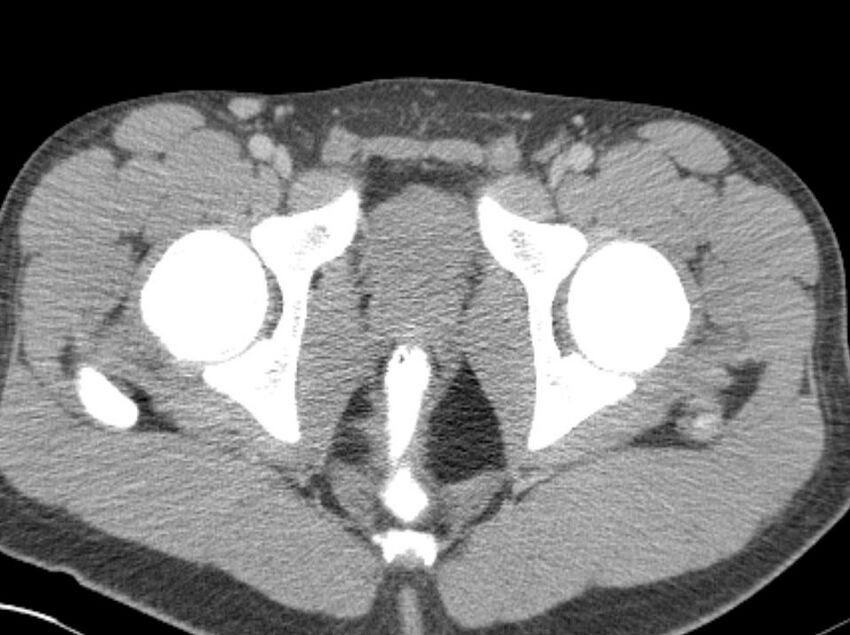 Appendicitis and incidental foregut duplication cyst (Radiopaedia 52962-58916 A 102).jpg