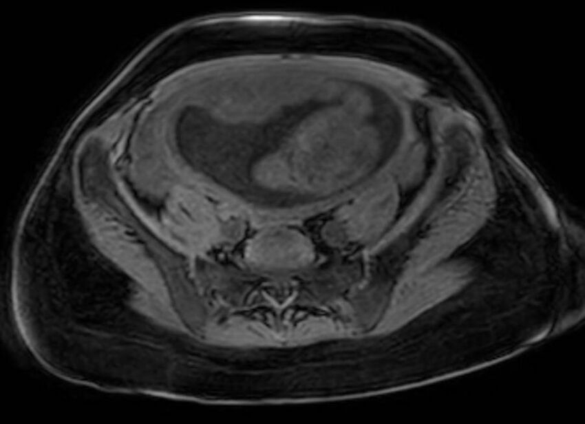 Appendicitis in gravida (MRI) (Radiopaedia 89433-106395 Axial DIXON 105).jpg