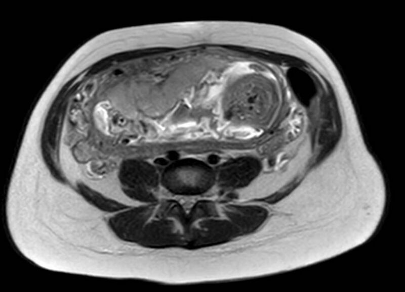File:Appendicitis in gravida (MRI) (Radiopaedia 89433-106395 Axial T2 43).jpg