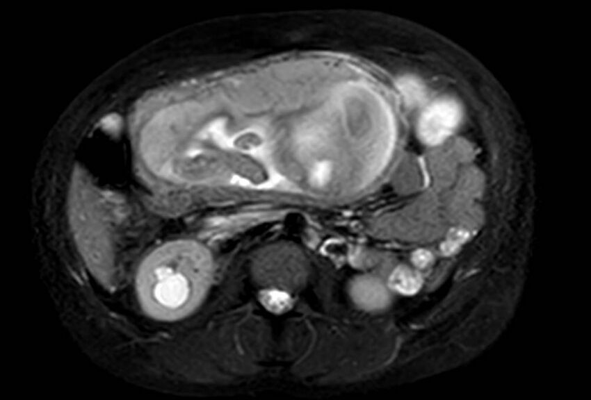 Appendicitis in gravida (MRI) (Radiopaedia 89433-106395 Axial T2 SPAIR 34).jpg