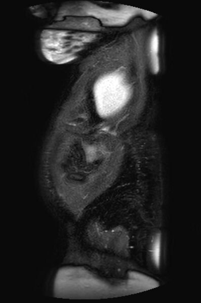 File:Appendicitis in gravida (MRI) (Radiopaedia 89433-106395 Sagittal T2 SPAIR 4).jpg