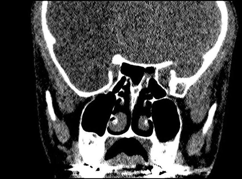 Arachnoid cyst- extremely large (Radiopaedia 68741-78450 Coronal bone window 35).jpg