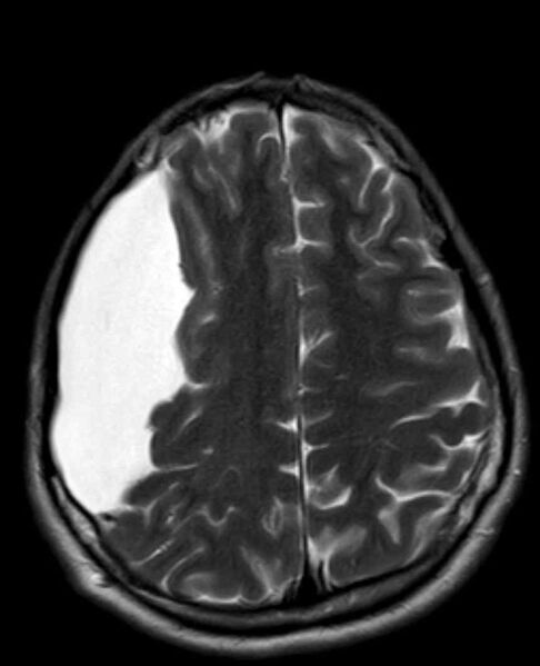 File:Arachnoid cyst- extremely large (Radiopaedia 68741-78451 Axial T2 20).jpg