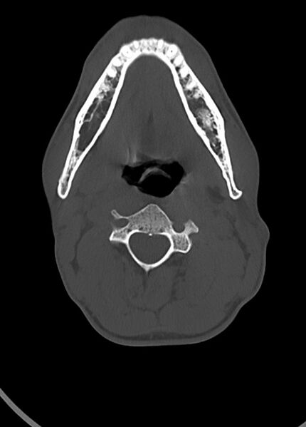 File:Arrow injury to the head (Radiopaedia 75266-86388 Axial bone window 20).jpg
