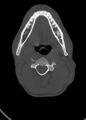 Arrow injury to the head (Radiopaedia 75266-86388 Axial bone window 20).jpg