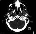 Arteriovenous malformation - cerebral (Radiopaedia 8172-14682 A 2).jpg