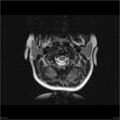 Arthrogryposis and muscle atrophy (Radiopaedia 24081-24314 T1 2).jpg