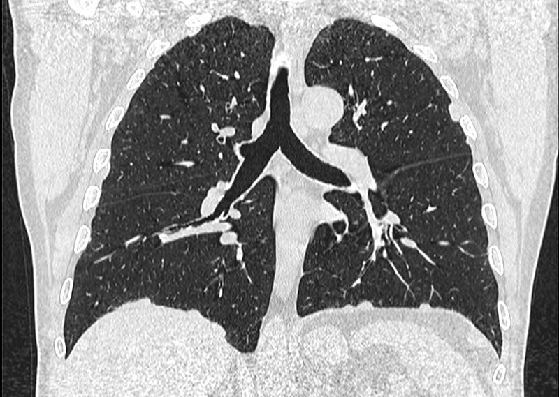 File:Asbestos pleural placques (Radiopaedia 57905-64872 Coronal lung window 165).jpg