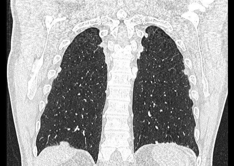 File:Asbestos pleural placques (Radiopaedia 57905-64872 Coronal lung window 232).jpg