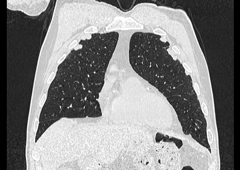 File:Asbestos pleural placques (Radiopaedia 57905-64872 Coronal lung window 64).jpg