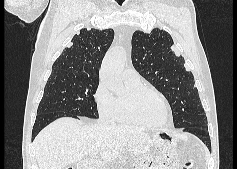 File:Asbestos pleural placques (Radiopaedia 57905-64872 Coronal lung window 81).jpg