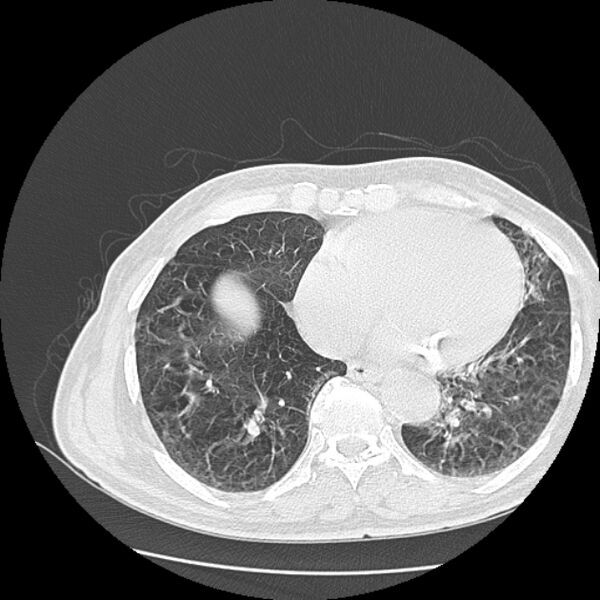 File:Aspergilloma (Radiopaedia 44592-48327 Axial lung window 65).jpg