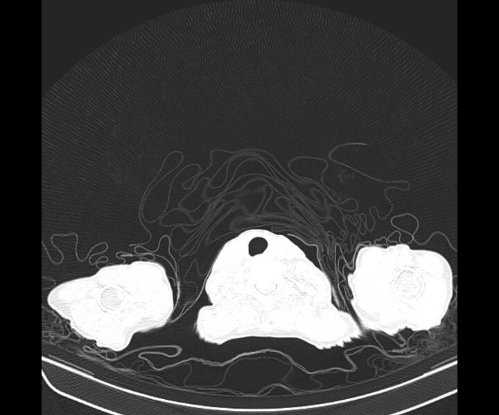File:Aspergillomas (Radiopaedia 66779-76110 Axial lung window 5).jpg