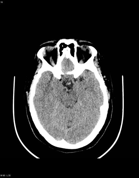 File:Astroblastoma (Radiopaedia 39792-42216 Axial non-contrast 17).jpg