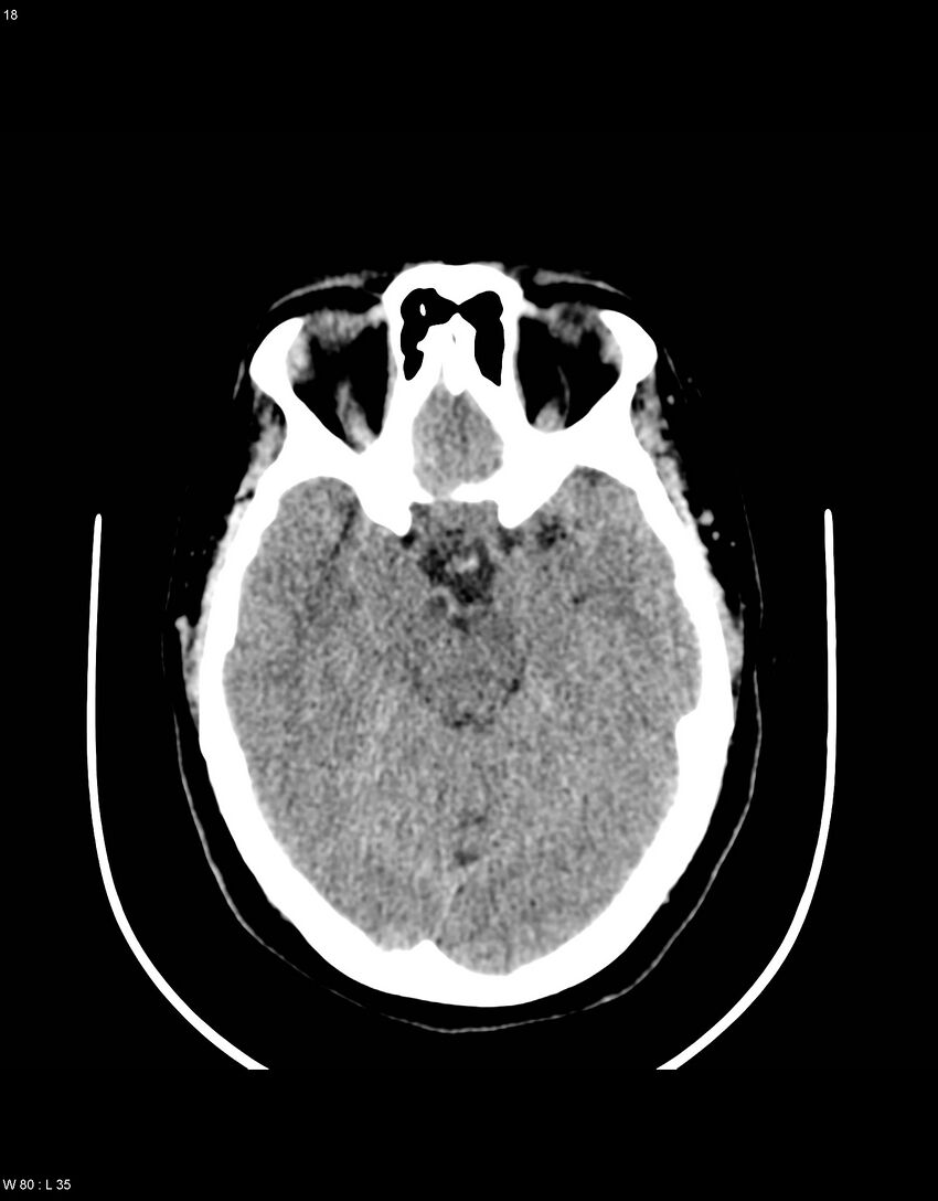 Astroblastoma (Radiopaedia 39792-42216 Axial non-contrast 17).jpg
