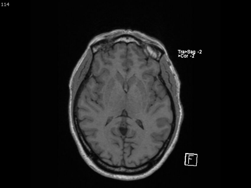 Atypical meningioma - intraosseous (Radiopaedia 64915-74572 Axial T1 114).jpg