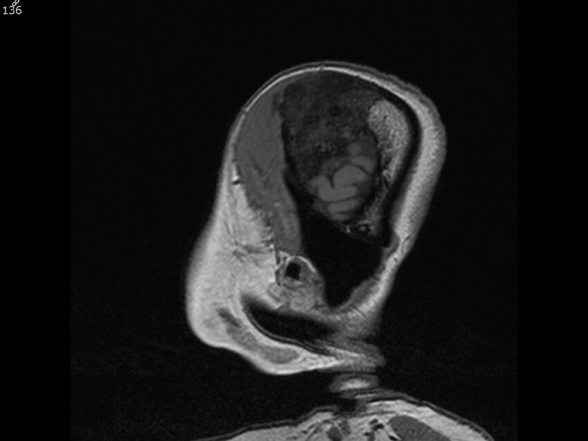 Atypical meningioma - intraosseous (Radiopaedia 64915-74572 Sagittal T1 136).jpg