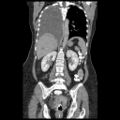 Atypical retroperitoneal lymphocoeles with large leiomyoma of uterus (Radiopaedia 32084-33024 B 15).jpg