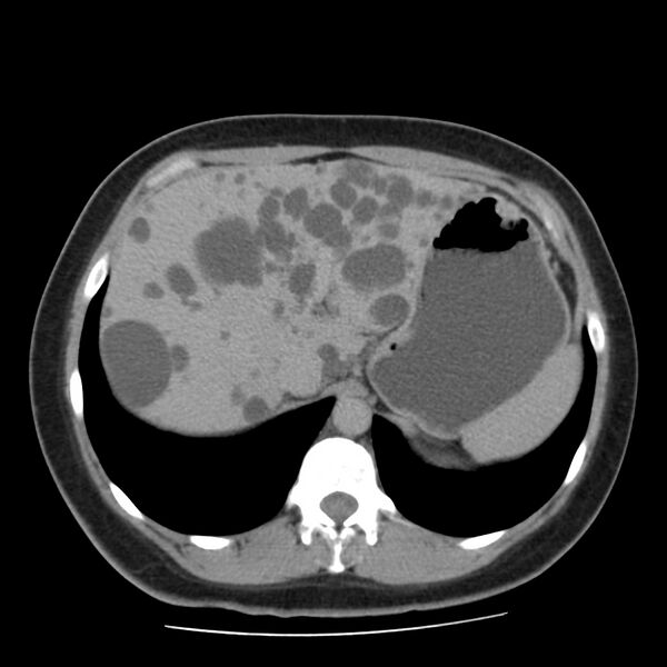 File:Autosomal dominant polycystic kidney disease (Radiopaedia 23061-23093 C+ delayed 14).jpg