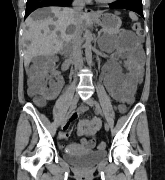 File:Autosomal dominant polycystic kidney disease (Radiopaedia 41918-44922 Coronal non-contrast 22).jpg