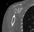Avulsion fracture - greater tuberosity of humerus (Radiopaedia 71216-81514 Coronal bone window 32).jpg