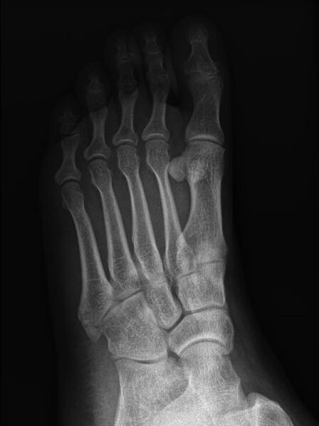 File:Avulsion fracture of the 5th metatarsal styloid - pseudo-Jones fracture (Radiopaedia 64009-72761 Oblique 1).JPG