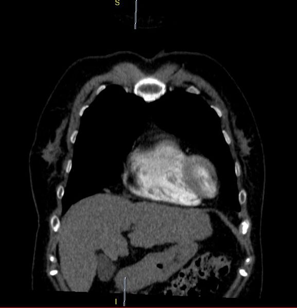 File:Azygos vein aneurysm (Radiopaedia 77824-90130 C 7).JPG