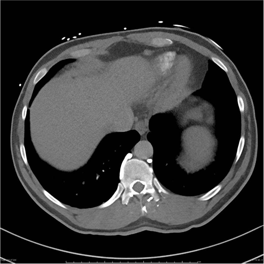 Azygos venous system anatomy (CT pulmonary angiography) (Radiopaedia 25928-26077 Axial C+ CTPA 74).jpg