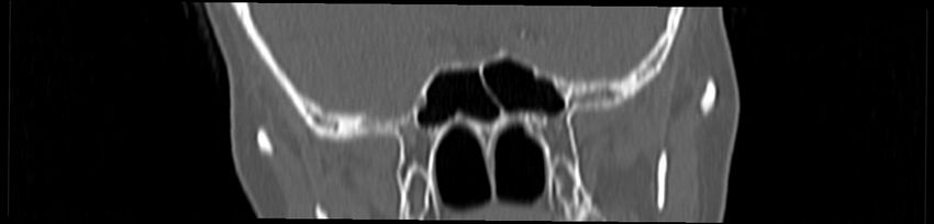 Basilar impression (Radiopaedia 52411-58522 Coronal bone window 14).jpg
