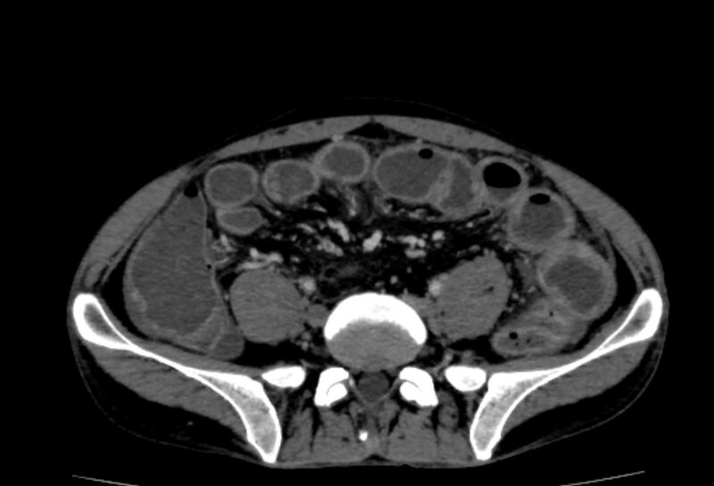 File:Behçet's disease- abdominal vasculitis (Radiopaedia 55955-62570 A 60).jpg