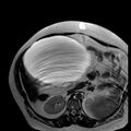 Benign seromucinous cystadenoma of the ovary (Radiopaedia 71065-81300 B 32).jpg
