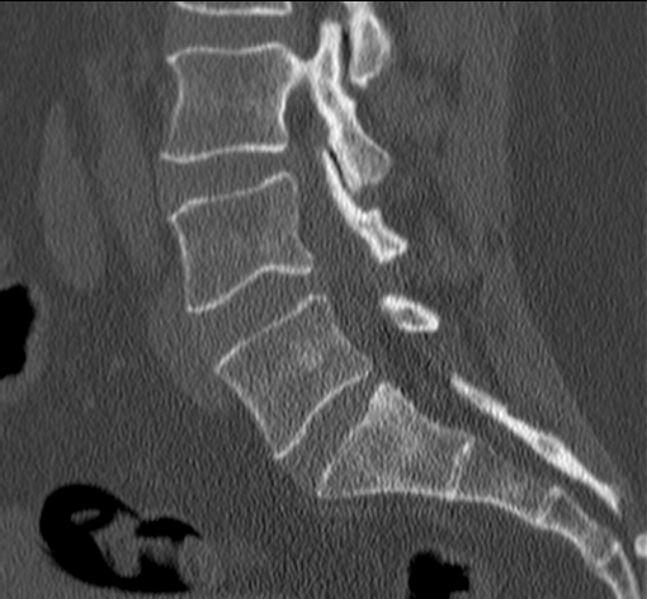File:Bertolotti syndrome (Radiopaedia 24864-25128 Sagittal bone window 32).jpg