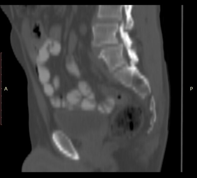 File:Bertolotti syndrome (Radiopaedia 58974-66235 Sagittal bone window 32).jpg