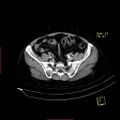 Bifid ureter (Radiopaedia 47604-52253 Axial C+ delayed 21).jpg